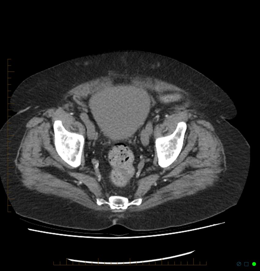 Acute renal failure post IV contrast injection- CT findings (Radiopaedia 47815-52557 Axial non-contrast 70).jpg