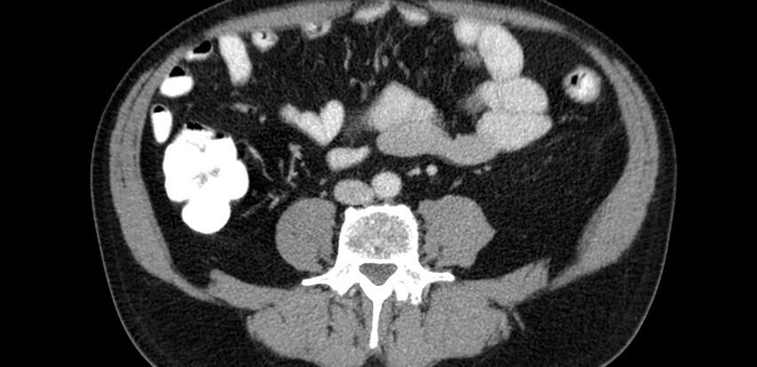 Acute sigmoid colon diverticulitis (Radiopaedia 55507-61976 Axial C+ portal venous phase 41).jpg
