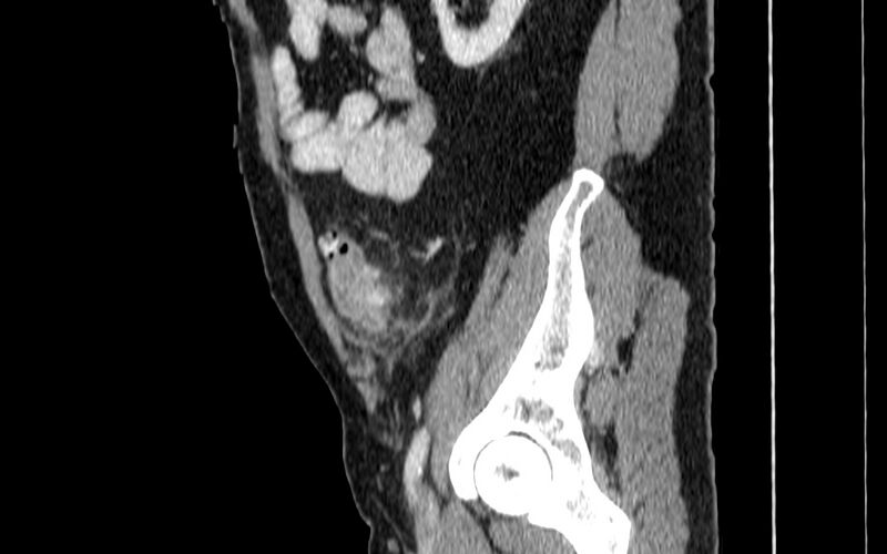 File:Acute sigmoid colon diverticulitis (Radiopaedia 55507-61976 Sagittal C+ portal venous phase 84).jpg