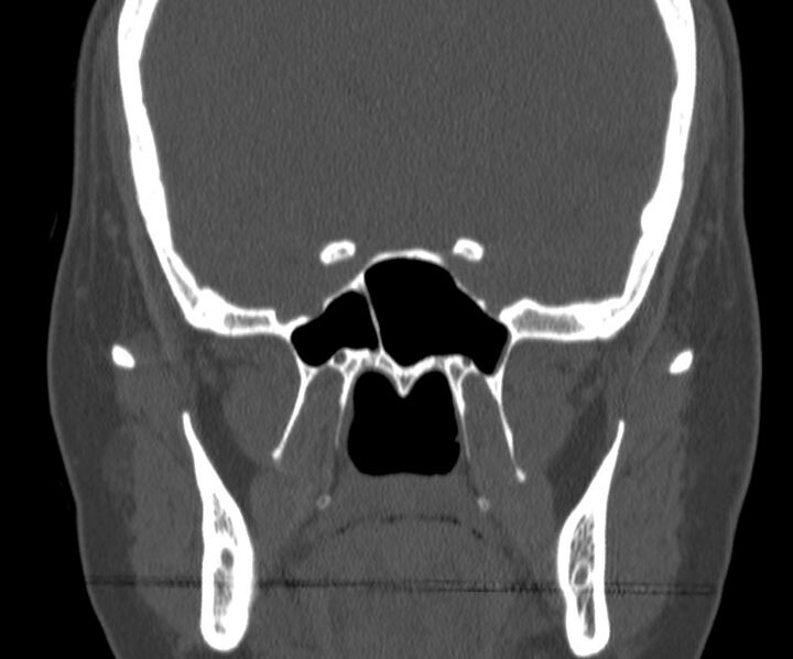 File:Acute sinusitis (Radiopaedia 22419-22455 Coronal bone window 30).jpg
