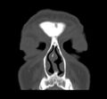 Acute sinusitis (Radiopaedia 23161-23215 Coronal bone window 20).jpg