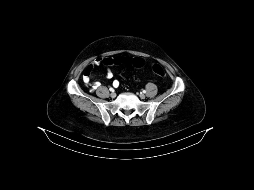 Adenocarcinoma of pancreas with hepatic metastasis (Radiopaedia 64332-73122 Axial C+ portal venous phase 76).jpg