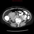 Adenocarcinoma of the colon (Radiopaedia 8191-9039 Axial renal excretory phase 26).jpg