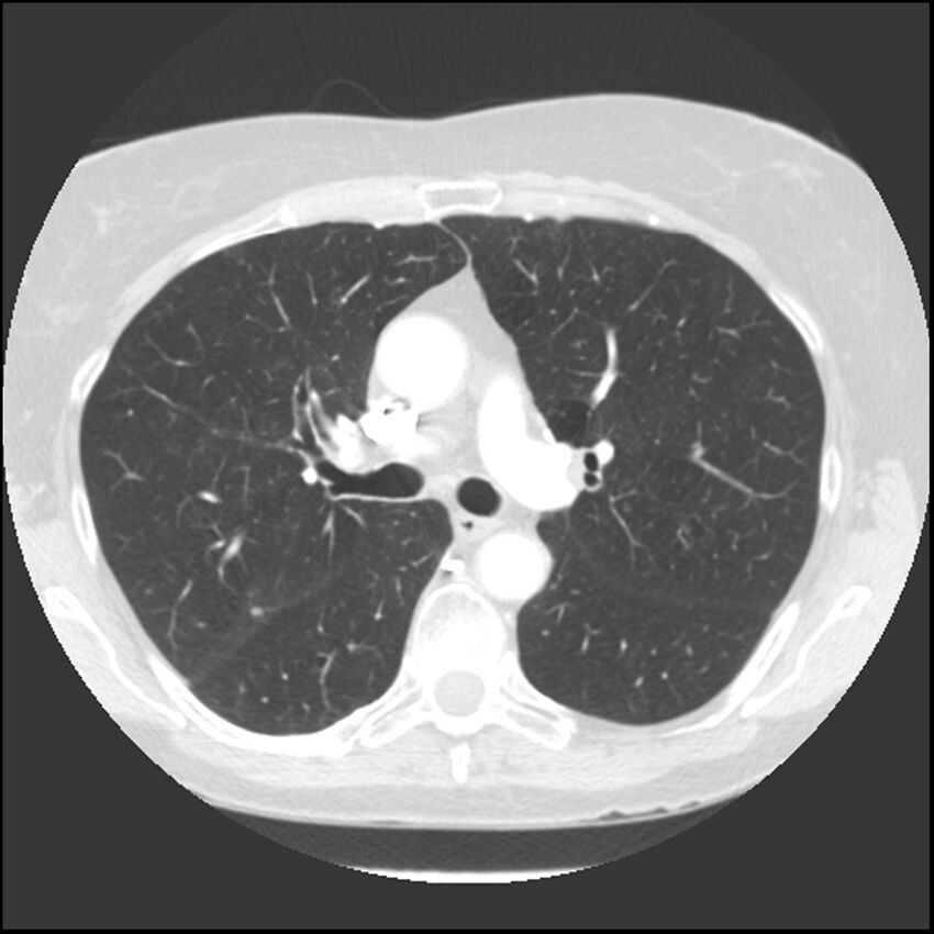Adenocarcinoma of the lung (Radiopaedia 41015-43755 Axial lung window 48).jpg