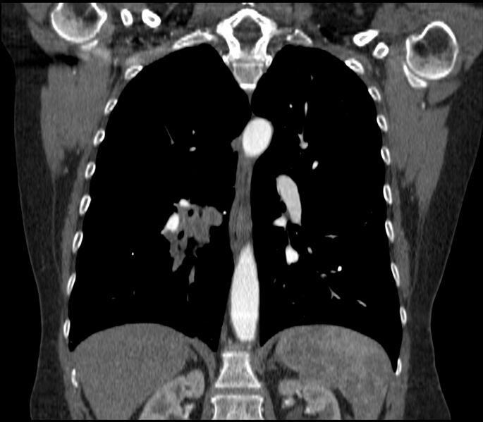 File:Adenocarcinoma of the lung (Radiopaedia 44205-47803 Coronal C+ portal venous phase 58).jpg