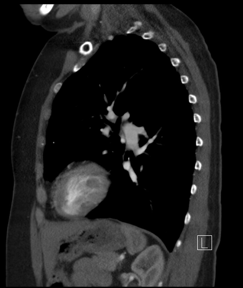 Adenocarcinoma of the lung (Radiopaedia 44205-47803 Sagittal C+ portal venous phase 20).jpg