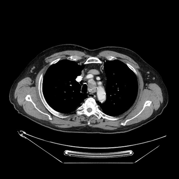 File:Adenocarcinoma of the lung (Radiopaedia 44876-48759 Axial C+ portal venous phase 22).jpg