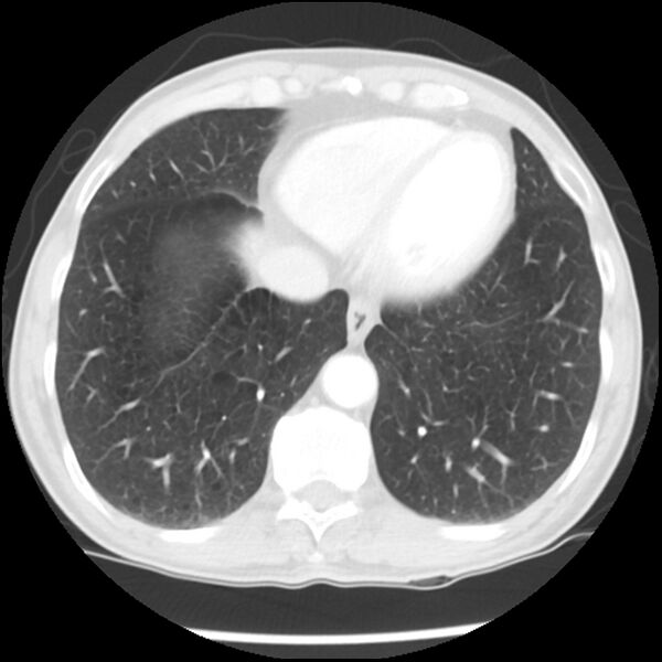 File:Adenocarcinoma of the lung - micropapillary predominant (Radiopaedia 42446-45563 Axial lung window 58).jpg