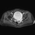 Adenomyoma of the uterus (huge) (Radiopaedia 9870-10438 Axial T1 C+ fat sat 12).jpg
