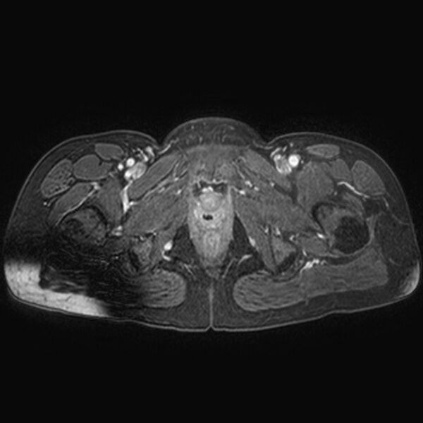 File:Adenomyoma of the uterus (huge) (Radiopaedia 9870-10438 Axial T1 C+ fat sat 5).jpg