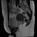 Adenomyosis and endometriotic cysts (Radiopaedia 82300-96367 Sagittal T2 5).jpg