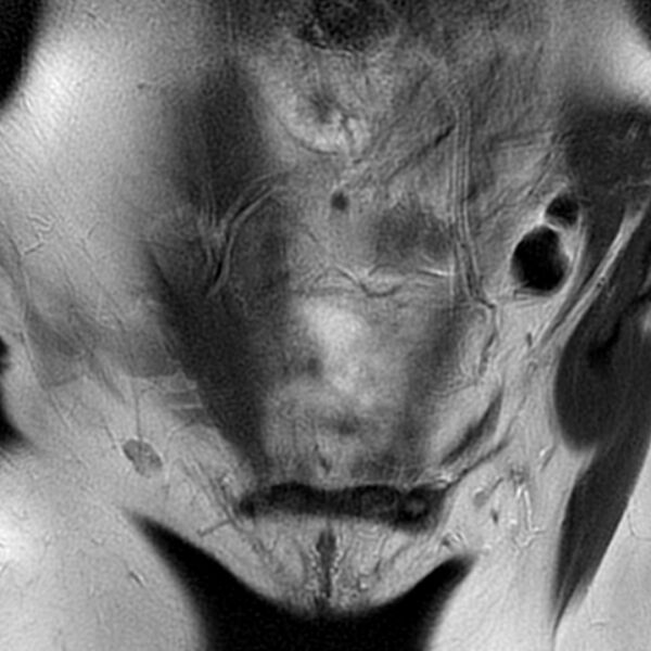 File:Adenomyosis within a septate uterus (Radiopaedia 69963-79981 Coronal T2 1).jpg