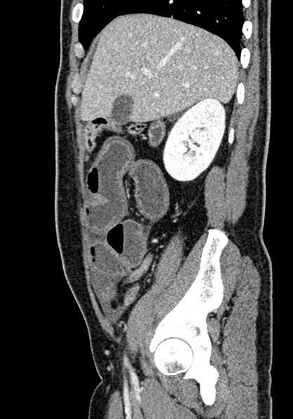 File:Adhesional small bowel obstruction (Radiopaedia 58900-66131 Sagittal C+ portal venous phase 68).jpg
