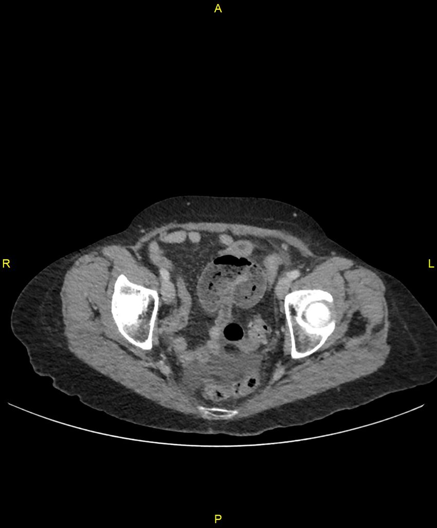 Adhesional small bowel obstruction (Radiopaedia 85402-101024 Axial C+ portal venous phase 254).jpg