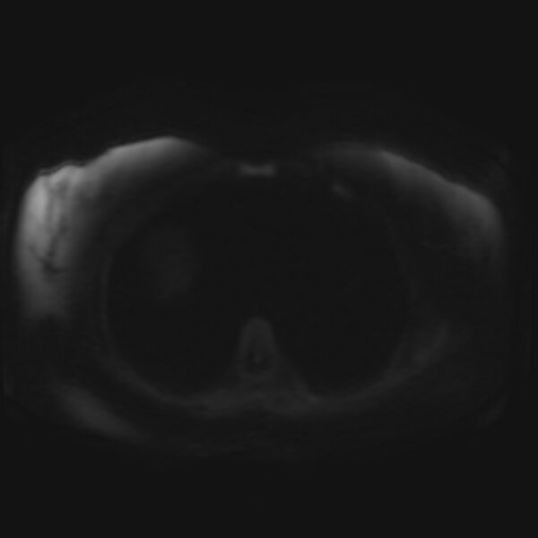 File:Adrenal cortical carcinoma (Radiopaedia 70906-81116 Axial DWI 28).jpg
