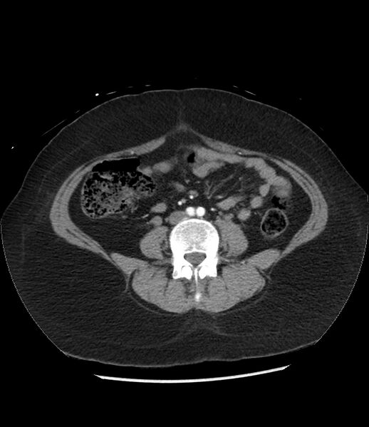 File:Adrenal cortical carcinoma with IVC invasion and thrombosis (Radiopaedia 34307-35597 Axial C+ arterial phase 53).jpg