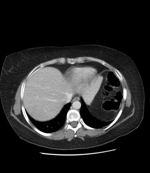 File:Adrenal cortical carcinoma with IVC invasion and thrombosis (Radiopaedia 34307-35597 Axial C+ portal venous phase 10).jpg