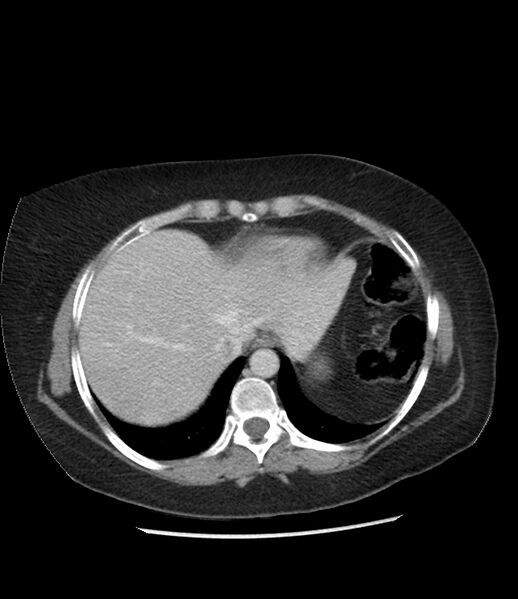 File:Adrenal cortical carcinoma with IVC invasion and thrombosis (Radiopaedia 34307-35597 Axial C+ portal venous phase 11).jpg