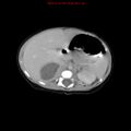 Adrenal hemorrhage (Radiopaedia 9390-10077 Axial C+ portal venous phase 6).jpg