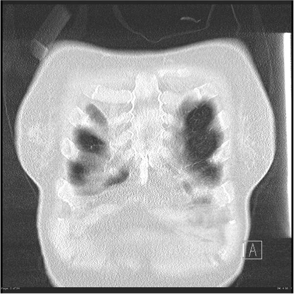 File:Alpha-1-antitrypsin deficiency (Radiopaedia 26537-26678 Coronal lung window 1).jpg