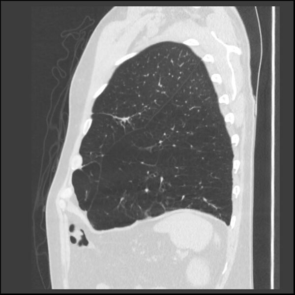 File:Alpha-1-antitrypsin deficiency (Radiopaedia 40993-43722 Sagittal lung window 50).jpg