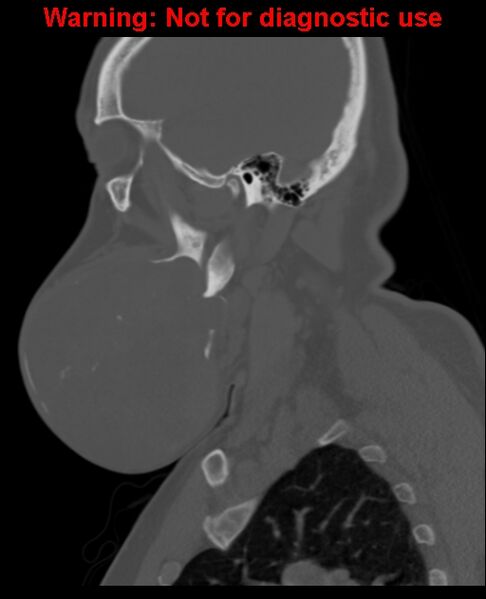 File:Ameloblastoma (Radiopaedia 33126-34164 Sagittal bone window 24).jpg
