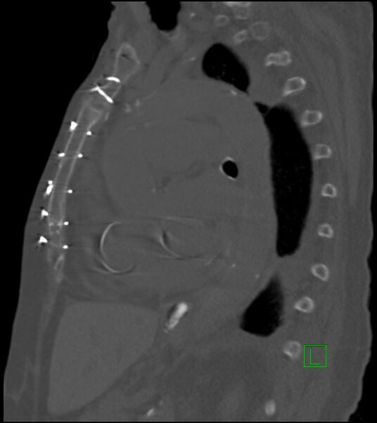 File:Amiodarone deposition in the liver (Radiopaedia 77587-89780 Sagittal bone window 44).jpg