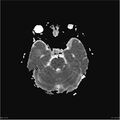 Amnestic syndrome secondary to hypoxic brain injury (Radiopaedia 24743-25004 ADC 11).jpg