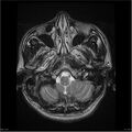 Amnestic syndrome secondary to hypoxic brain injury (Radiopaedia 24743-25004 T2 3).jpg