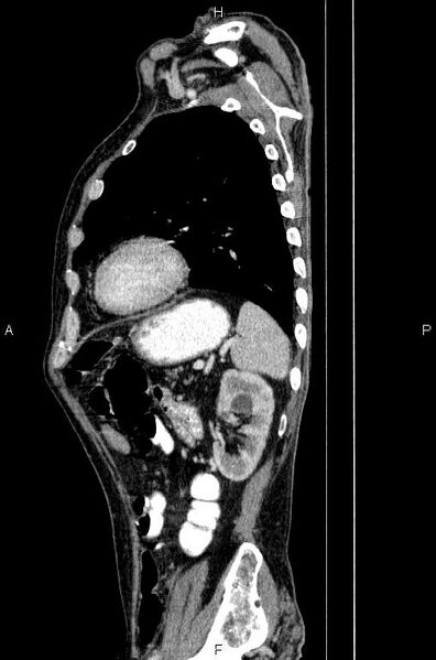 File:Ampullary adenocarcinoma (Radiopaedia 86093-102033 E 70).jpg