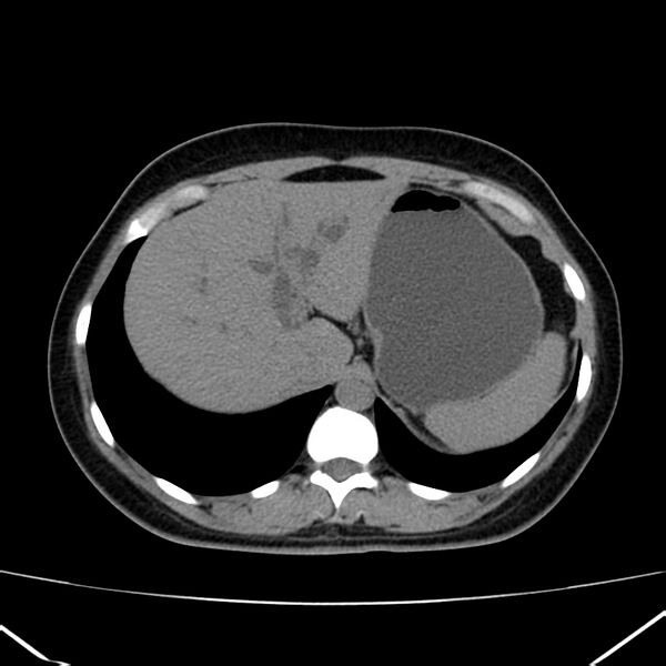 File:Ampullary tumor (Radiopaedia 22787-22816 Axial non-contrast 11).jpg