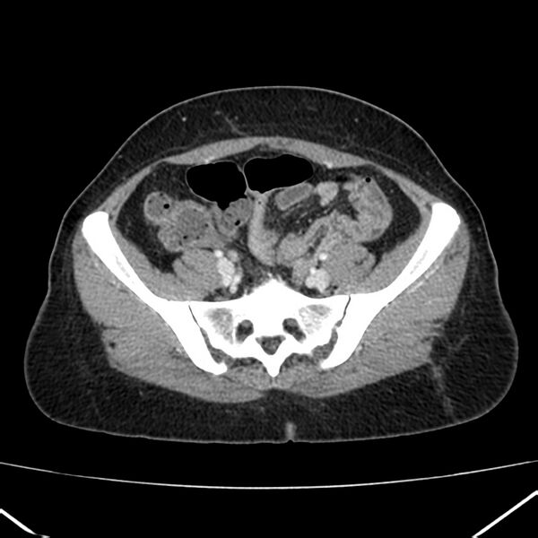File:Ampullary tumor (Radiopaedia 22787-22816 C 52).jpg