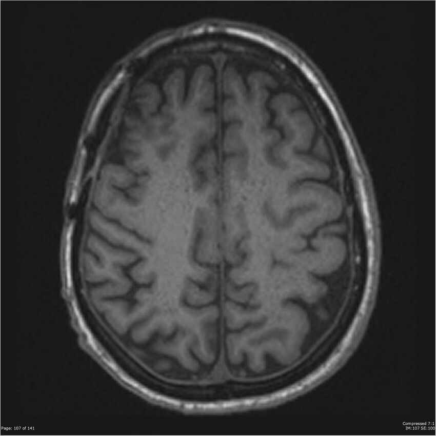 Anaplastic meningioma with recurrence (Radiopaedia 34452-35788 Axial T1 105).jpg