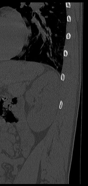 File:Aneurysmal bone cyst T11 (Radiopaedia 29294-29721 Sagittal bone window 3).jpg