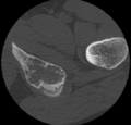 Aneurysmal bone cyst of ischium (Radiopaedia 25957-26094 B 43).png