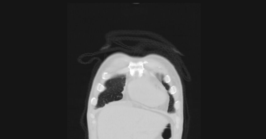 Angioinvasive aspergellosis (Radiopaedia 66995-76315 Coronal lung window 3).jpg