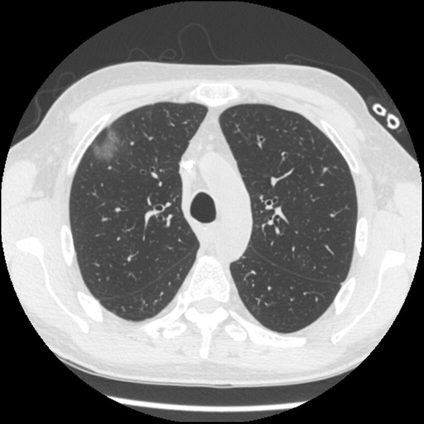 Angioinvasive aspergillosis (Radiopaedia 43957-47466 Axial lung window 22).jpg