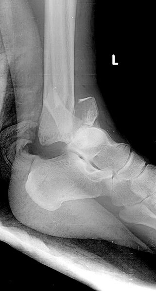 File:Ankle fracture - Weber C (Radiopaedia 69316-79144 Lateral 1).jpg