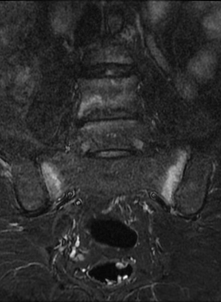 File:Ankylosing spondylitis - Andersson lesion (Radiopaedia 81878-95838 Coronal STIR 6).jpg