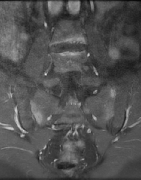 File:Ankylosing spondylitis - Andersson lesion (Radiopaedia 81878-95838 H 7).jpg