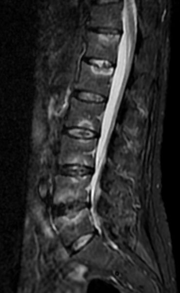 File:Ankylosing spondylitis - Andersson lesion (Radiopaedia 81878-95838 Sagittal STIR 6).jpg
