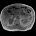 Annular pancreas (Radiopaedia 38292-40320 Axial T1 IN-OPP 41).png