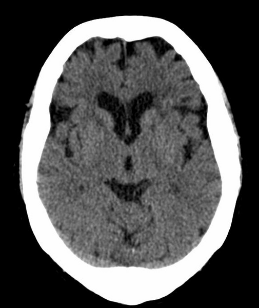 File:Anomalous intracranial venous drainage (Radiopaedia 28161-28418 Axial 25).png