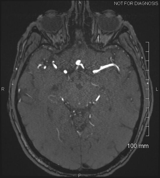 File:Anterior cerebral artery aneurysm (Radiopaedia 80683-94127 Axial MRA 103).jpg