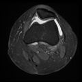 Anterior cruciate ligament tear, Wrisberg rip and bucket-handle tear of medial meniscus (Radiopaedia 75872-87266 Axial PD fat sat 20).jpg