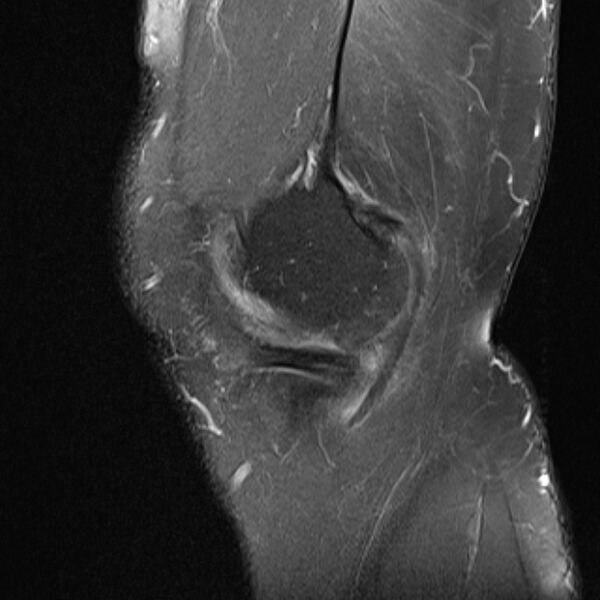 File:Anterior cruciate ligament tear - ramp lesion (Radiopaedia 71883-82322 Sagittal PD fat sat 22).jpg
