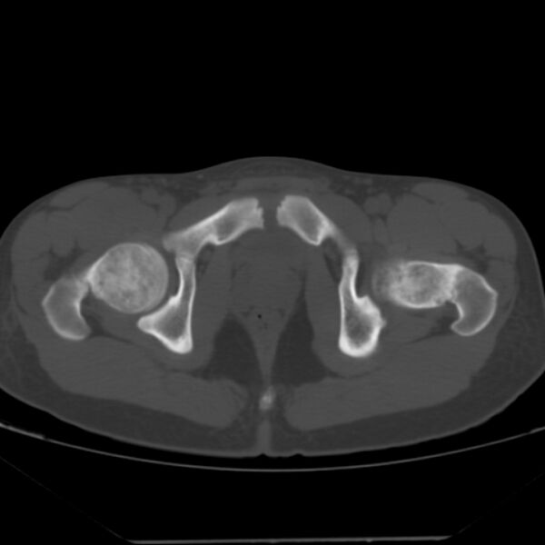 File:Anterior inferior iliac spine avulsion fracture (Radiopaedia 49469-54627 Axial bone window 46).jpg