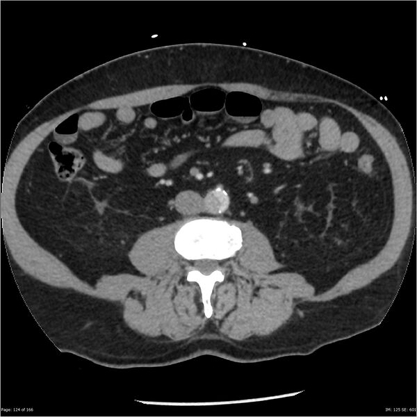 File:Aortic dissection- Stanford A (Radiopaedia 37759-39664 A 115).jpg
