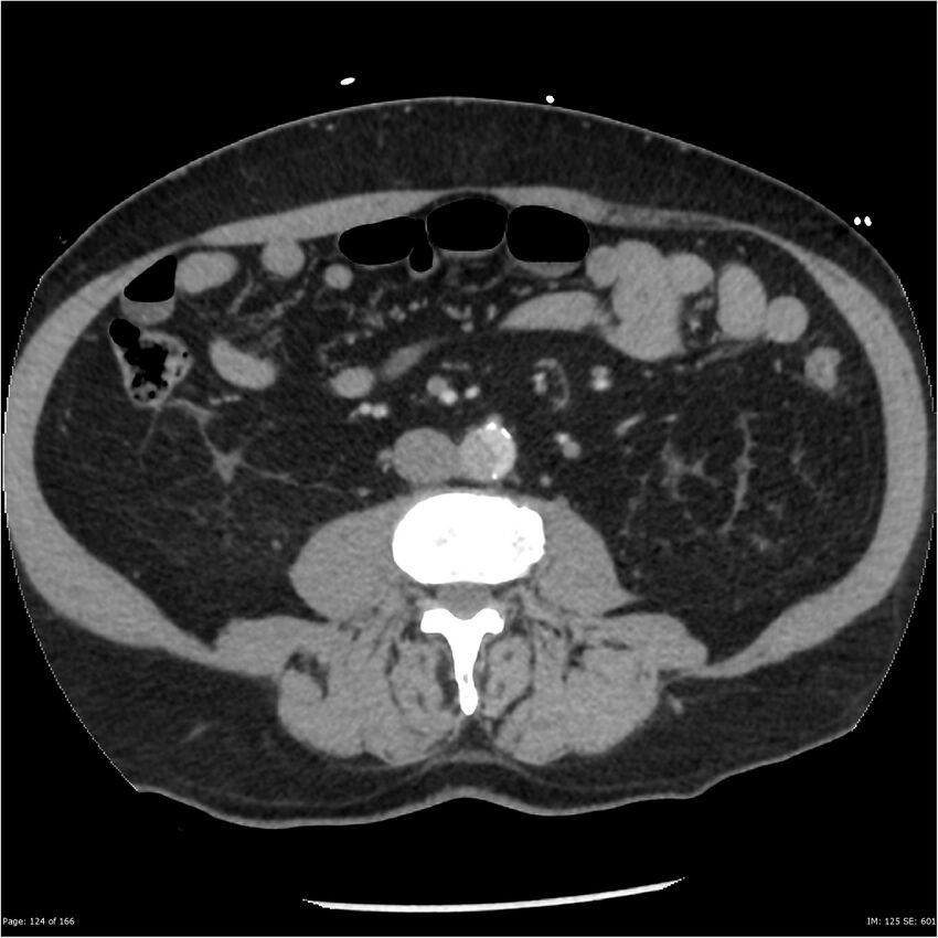 Aortic dissection- Stanford A (Radiopaedia 37759-39664 A 115).jpg