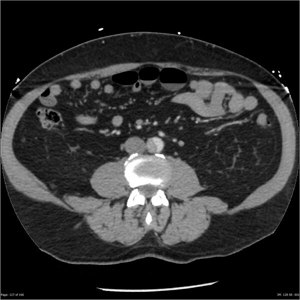 File:Aortic dissection- Stanford A (Radiopaedia 37759-39664 A 118).jpg